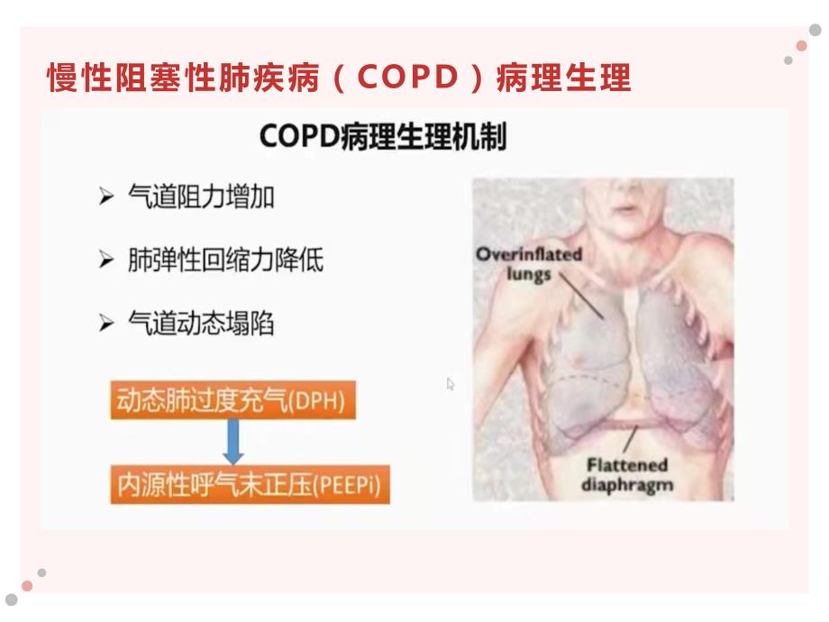 AECOPD机械通气演示文稿_第2页