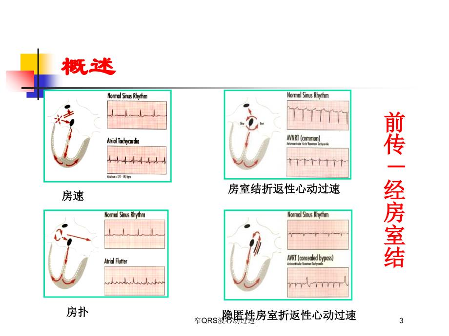 窄QRS波心动过速培训课件_第3页