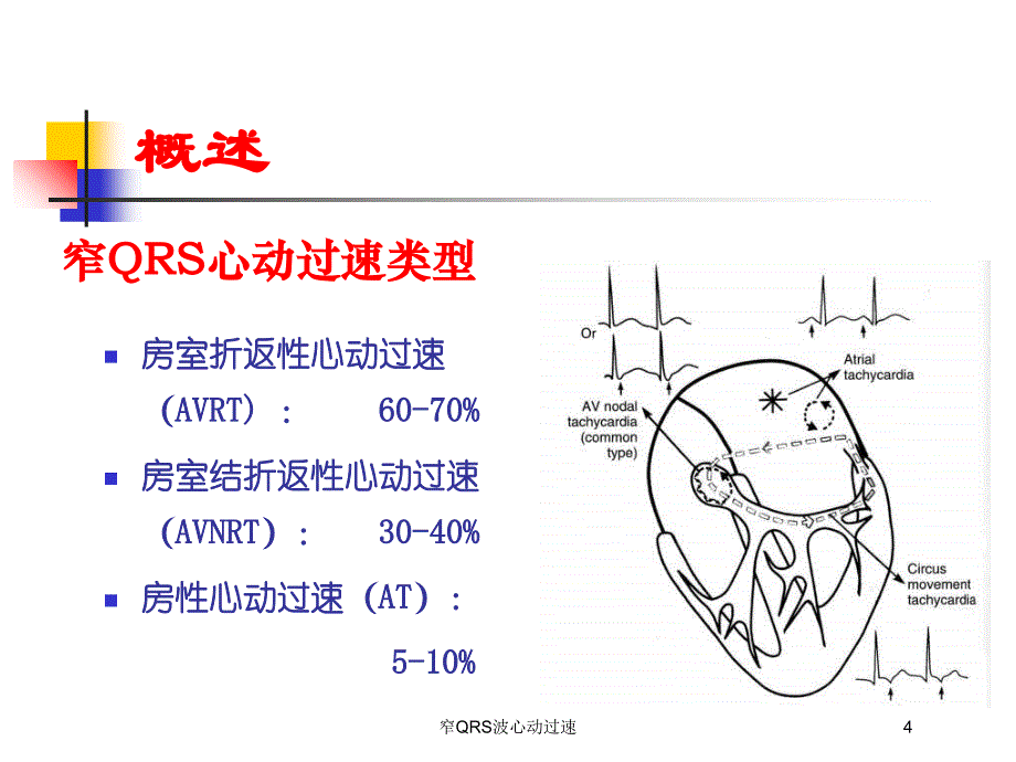 窄QRS波心动过速培训课件_第4页