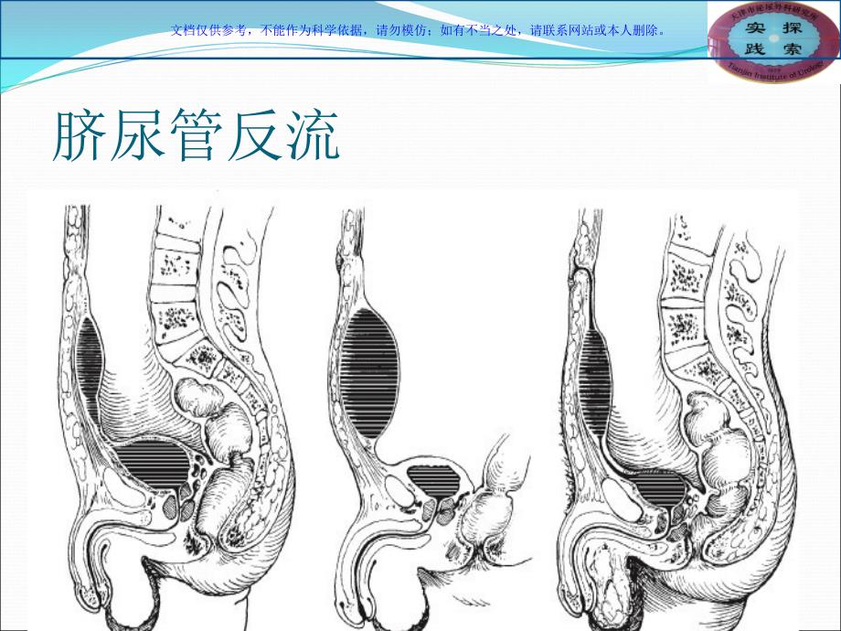 膀胱相关知识学习和探讨课件_第4页