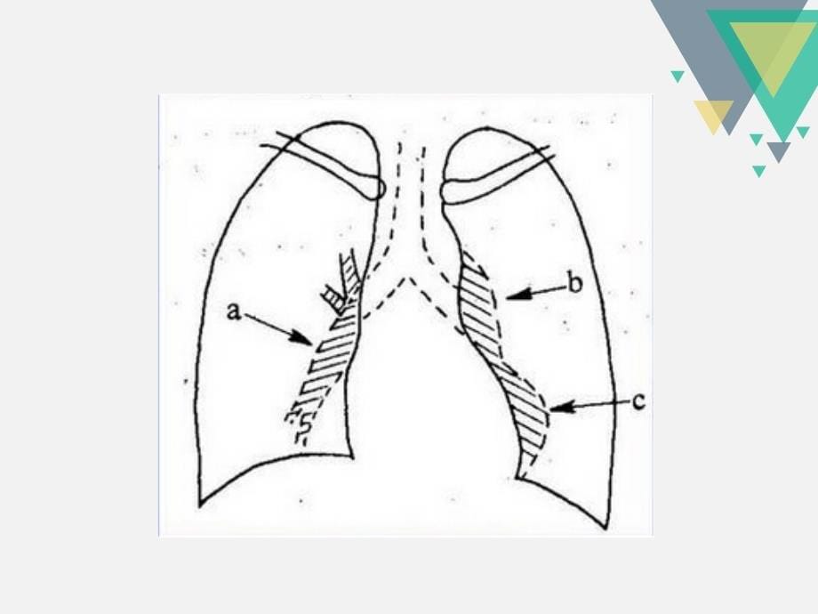 肺源性心脏病的影像诊疗_第5页