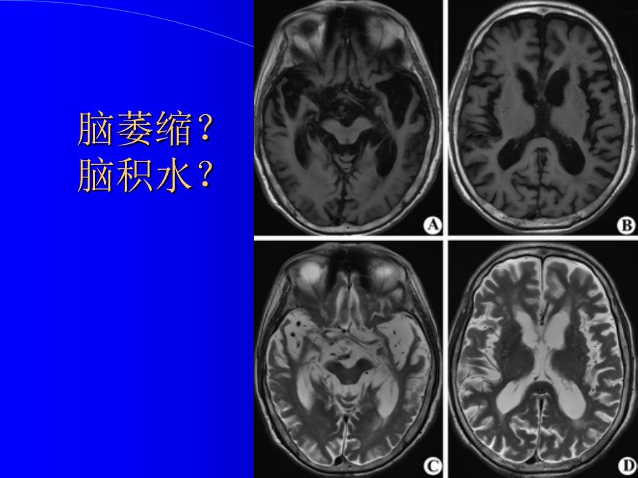 脑积水和脑萎缩的CT和MRI诊疗_第3页