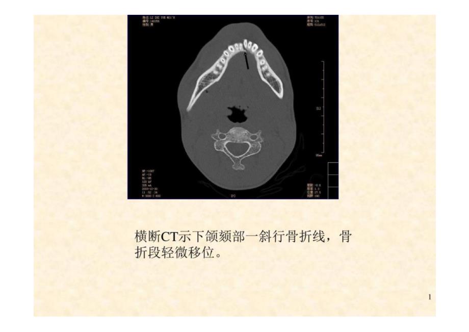 《口腔影像学》第8章 颌骨骨折-教学课件（非AI生成）_第1页