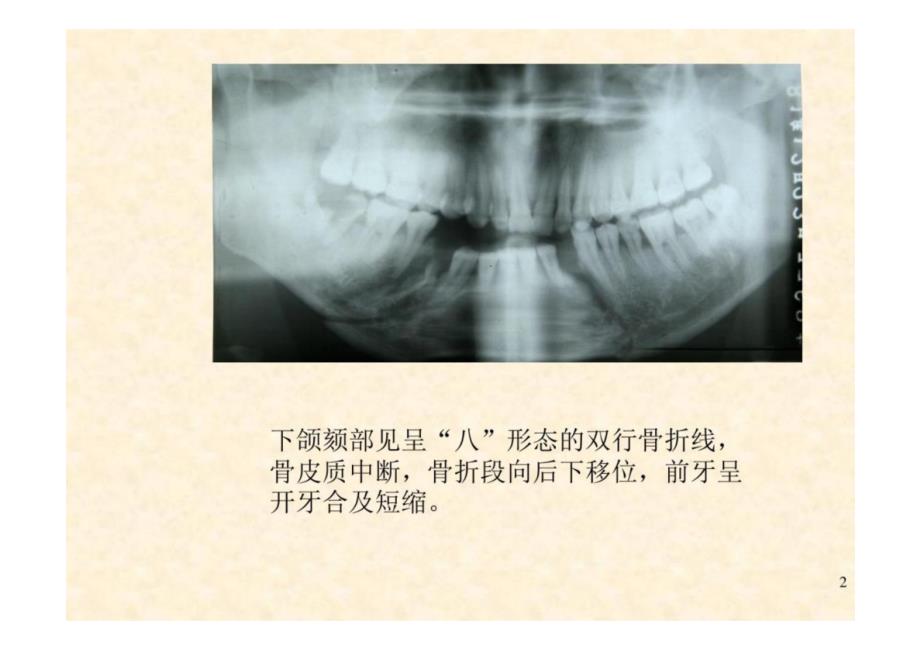 《口腔影像学》第8章 颌骨骨折-教学课件（非AI生成）_第2页