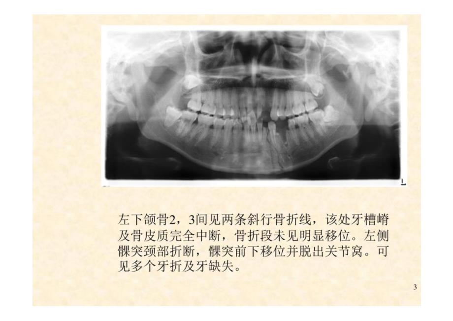 《口腔影像学》第8章 颌骨骨折-教学课件（非AI生成）_第3页