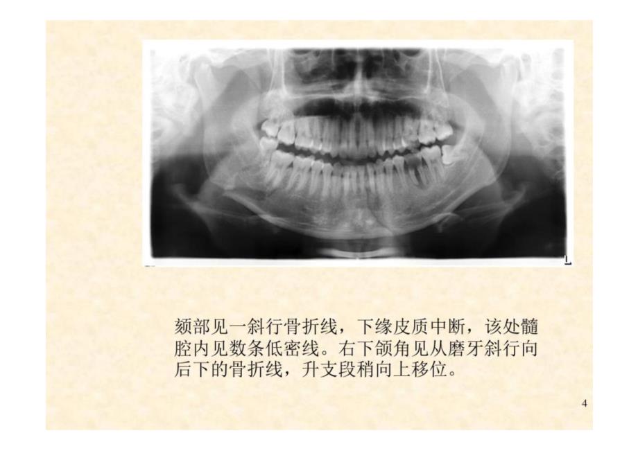 《口腔影像学》第8章 颌骨骨折-教学课件（非AI生成）_第4页