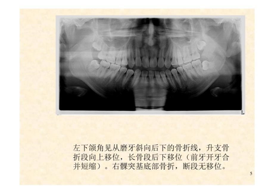 《口腔影像学》第8章 颌骨骨折-教学课件（非AI生成）_第5页