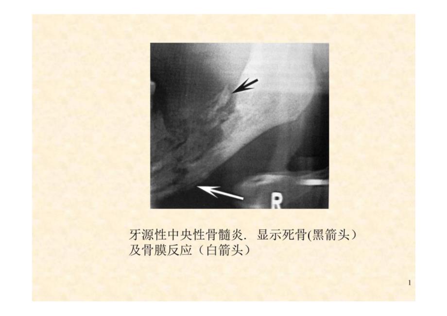 《口腔影像学》第6章 颌骨炎症-教学课件（非AI生成）_第1页