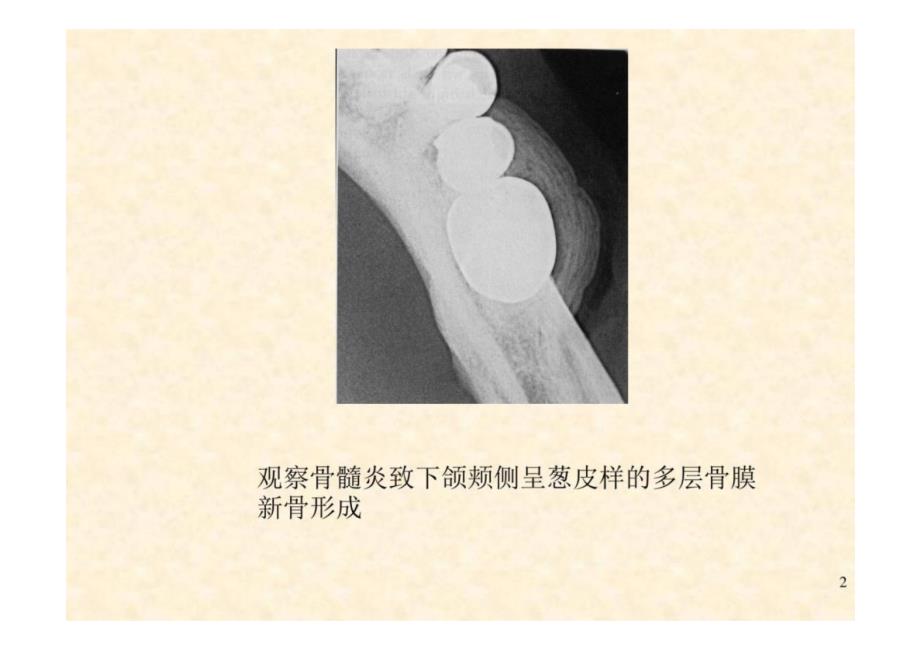 《口腔影像学》第6章 颌骨炎症-教学课件（非AI生成）_第2页