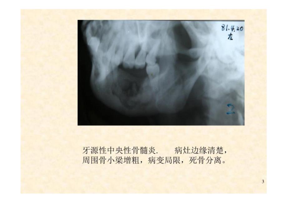 《口腔影像学》第6章 颌骨炎症-教学课件（非AI生成）_第3页