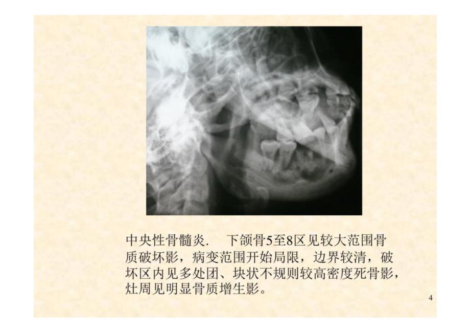 《口腔影像学》第6章 颌骨炎症-教学课件（非AI生成）_第4页