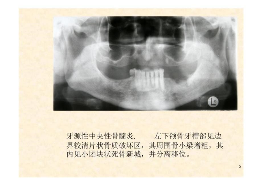 《口腔影像学》第6章 颌骨炎症-教学课件（非AI生成）_第5页