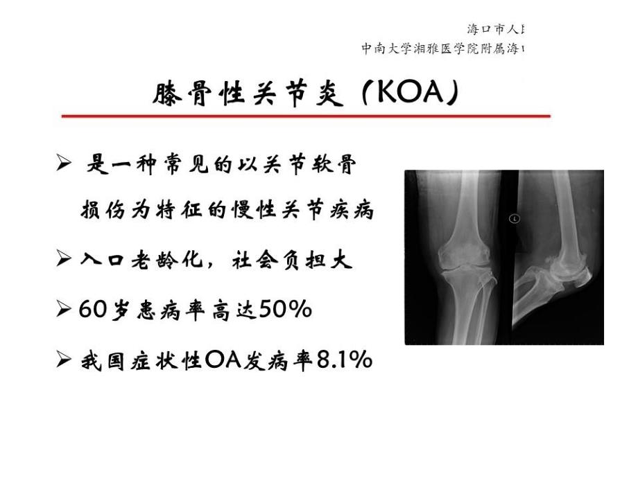 医学教材 Oxford内侧单髁置换术治疗膝骨性关节炎_第2页