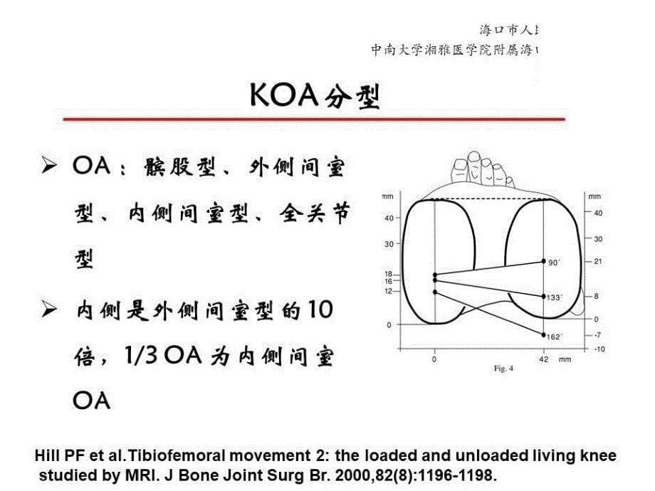 医学教材 Oxford内侧单髁置换术治疗膝骨性关节炎_第5页