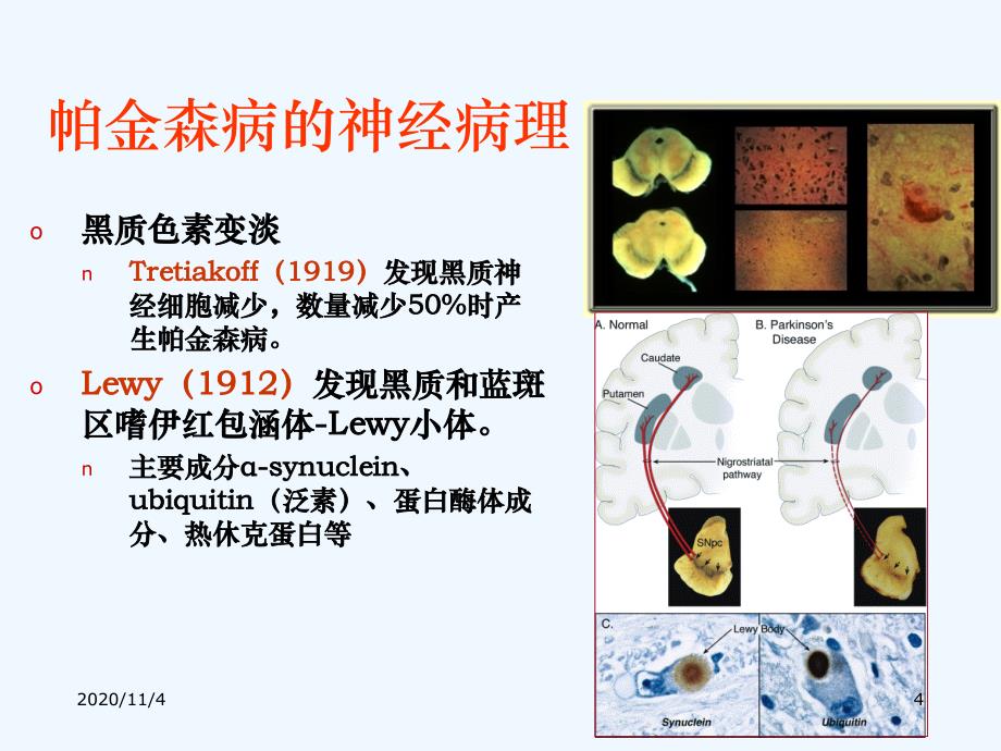 医学教材 从发病过程重新帕金森病的诊断及治疗_第4页