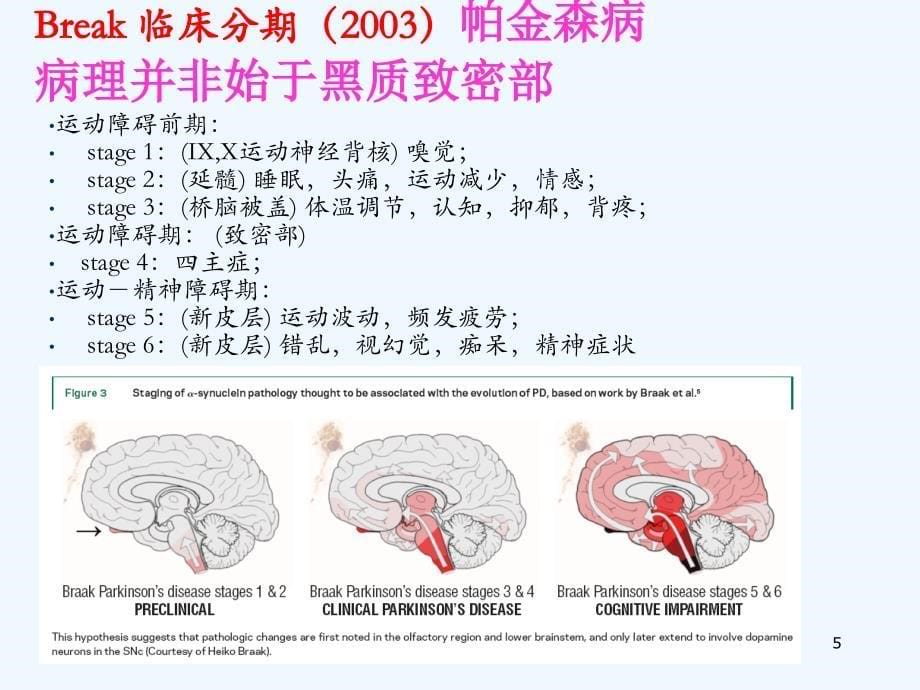 医学教材 从发病过程重新帕金森病的诊断及治疗_第5页