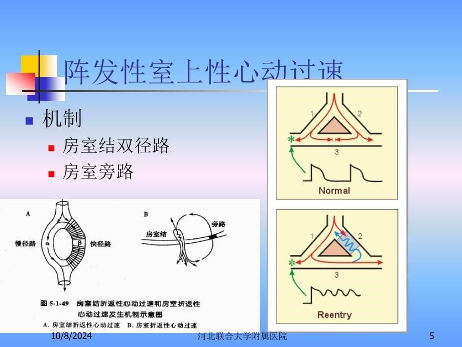 医学教程 第三节 心律失常 激动形成异常 异位心动过速_第5页