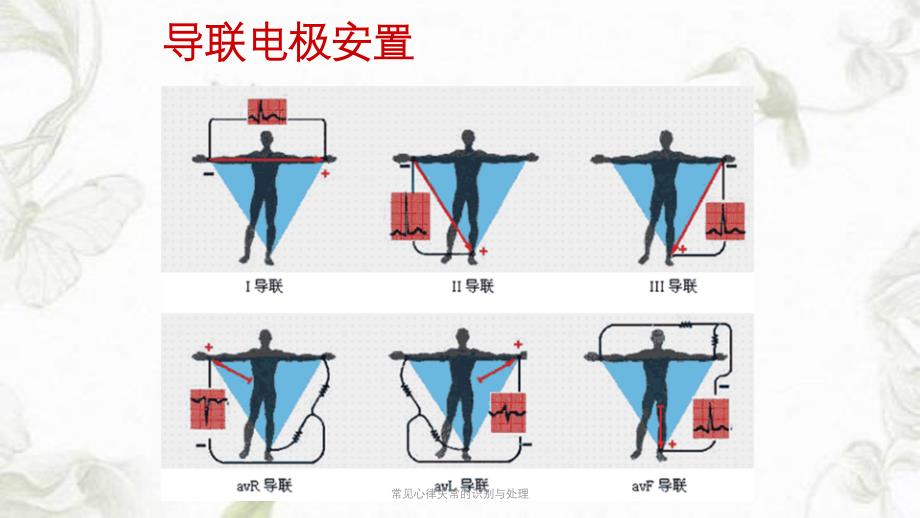 医学教程 常见心律失常的识别与处理课件_第3页