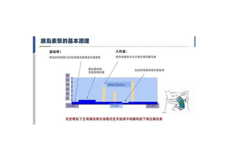 胰岛素泵的应用与护理2024课件_第5页