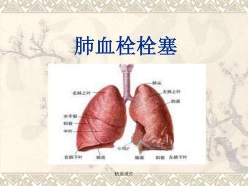 肺栓塞(讲课教学)
