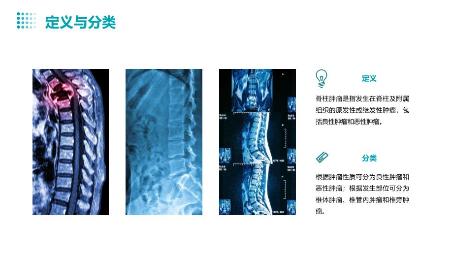 脊柱肿瘤影像诊断检查护理课件_第4页