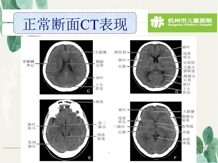 颅脑常见疾病C表现_第5页