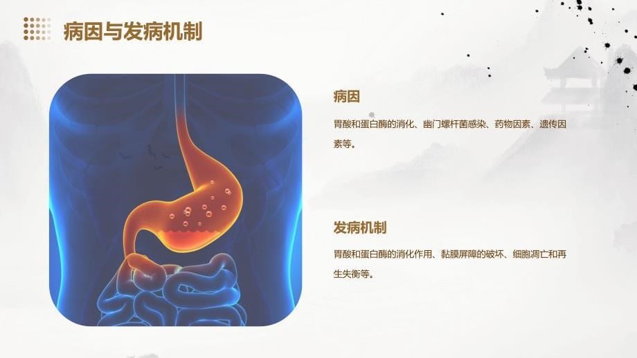 《消化性溃疡诊治》课件_第5页