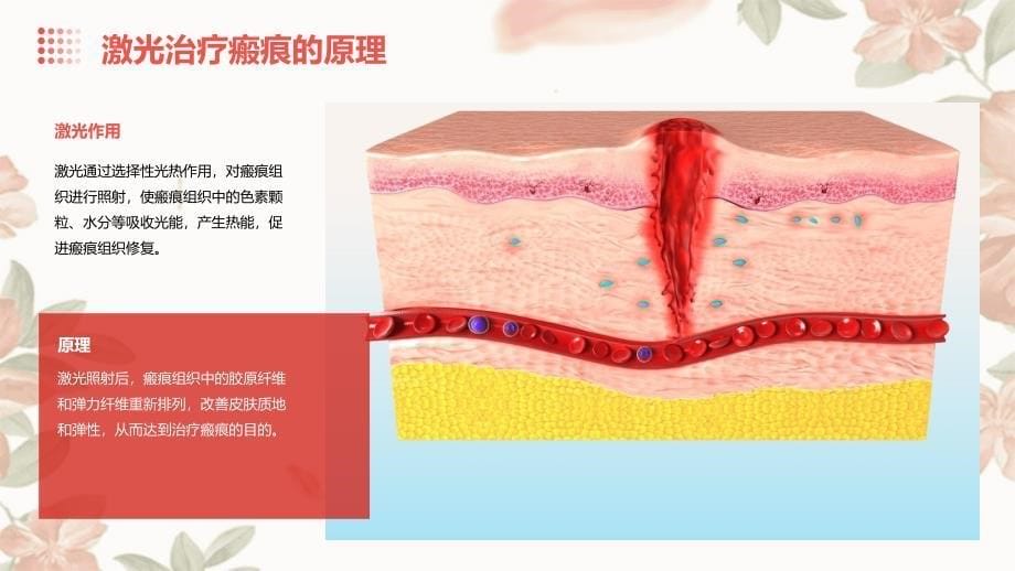 《激光治疗瘢痕》课件_第5页