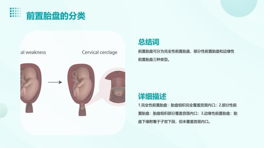 前置胎盘护理查房培训_第5页