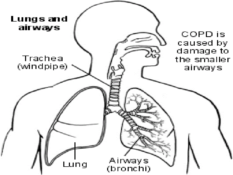 《呼吸内科-COPD、慢性支气管炎》医学课件_第4页