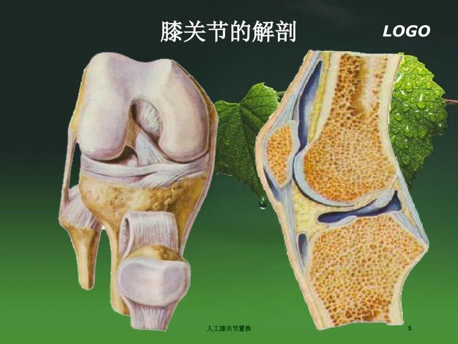 人工膝关节置换培训课件_第5页