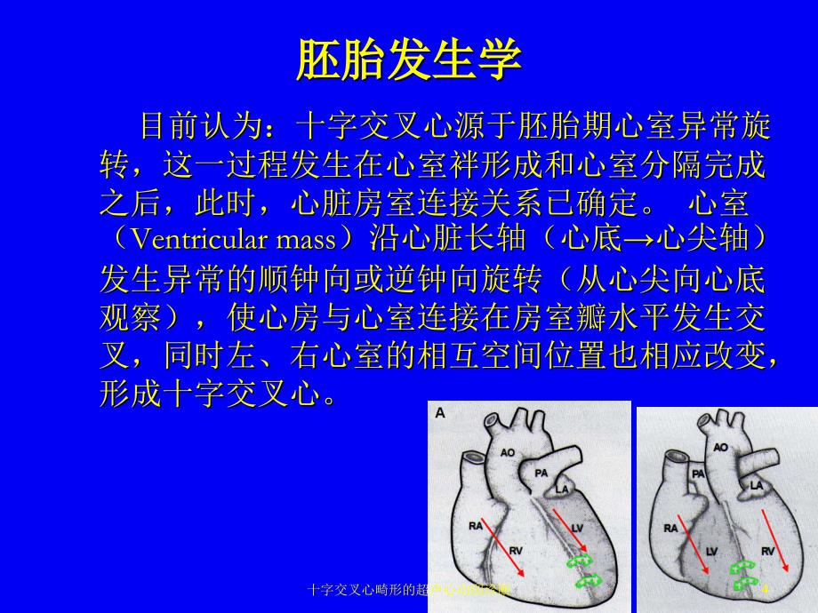 十字交叉心畸形的超声心动图诊断培训课件_第4页