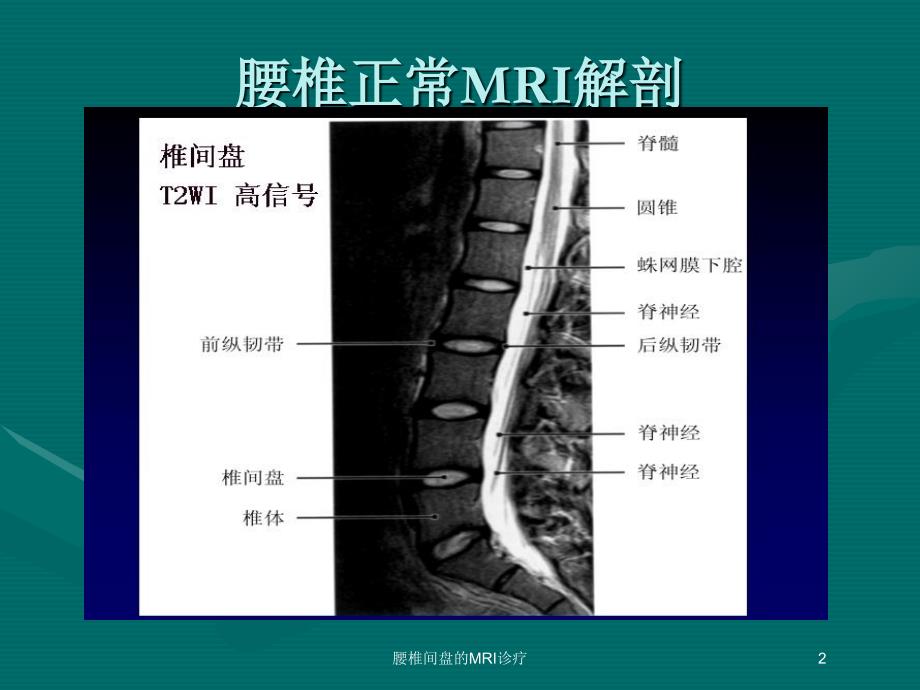 腰椎间盘的MRI诊疗培训课件_第2页