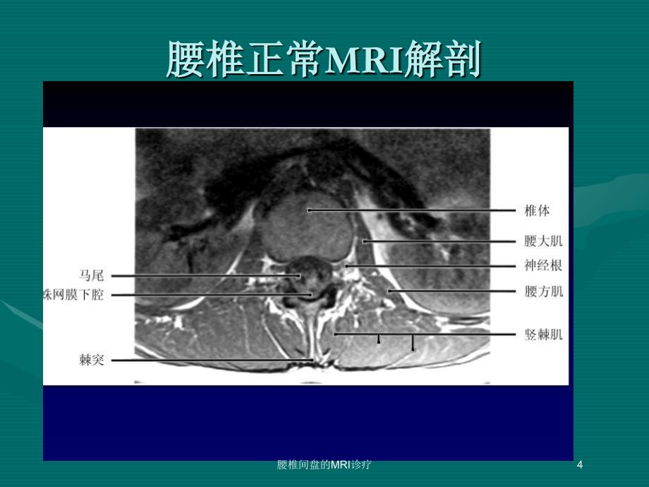 腰椎间盘的MRI诊疗培训课件_第4页