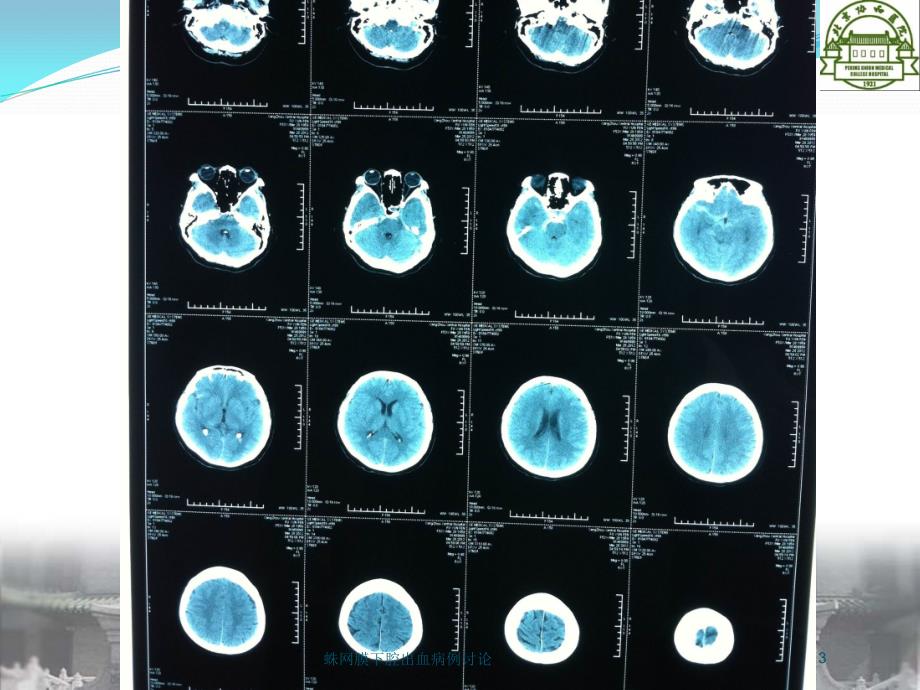 蛛网膜下腔出血病例讨论培训课件_第3页