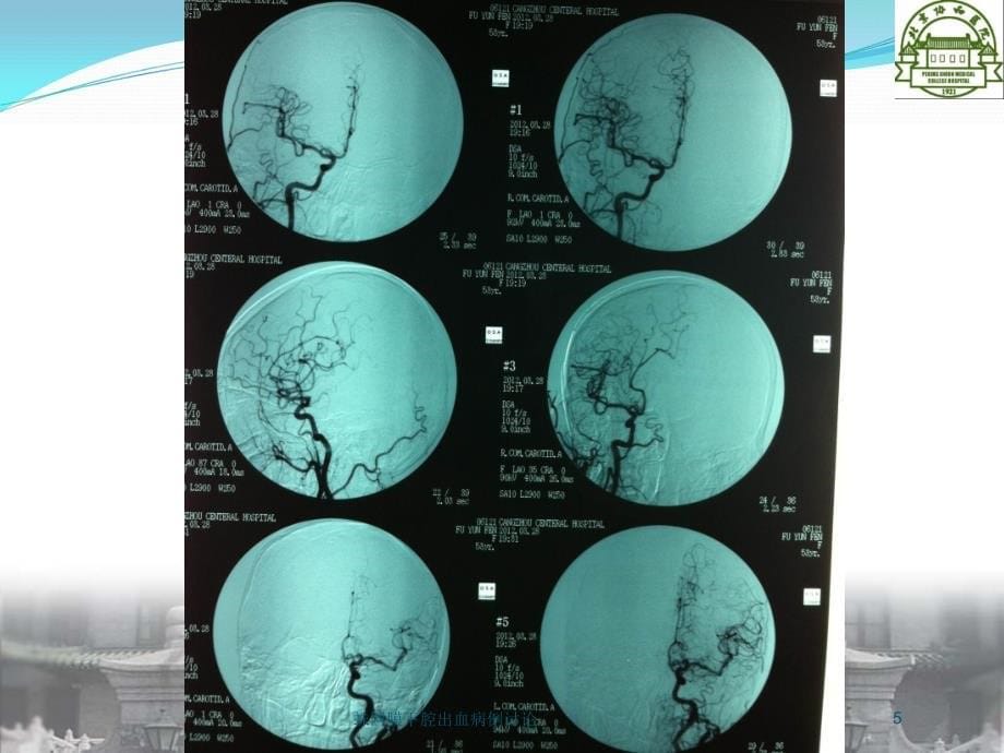 蛛网膜下腔出血病例讨论培训课件_第5页