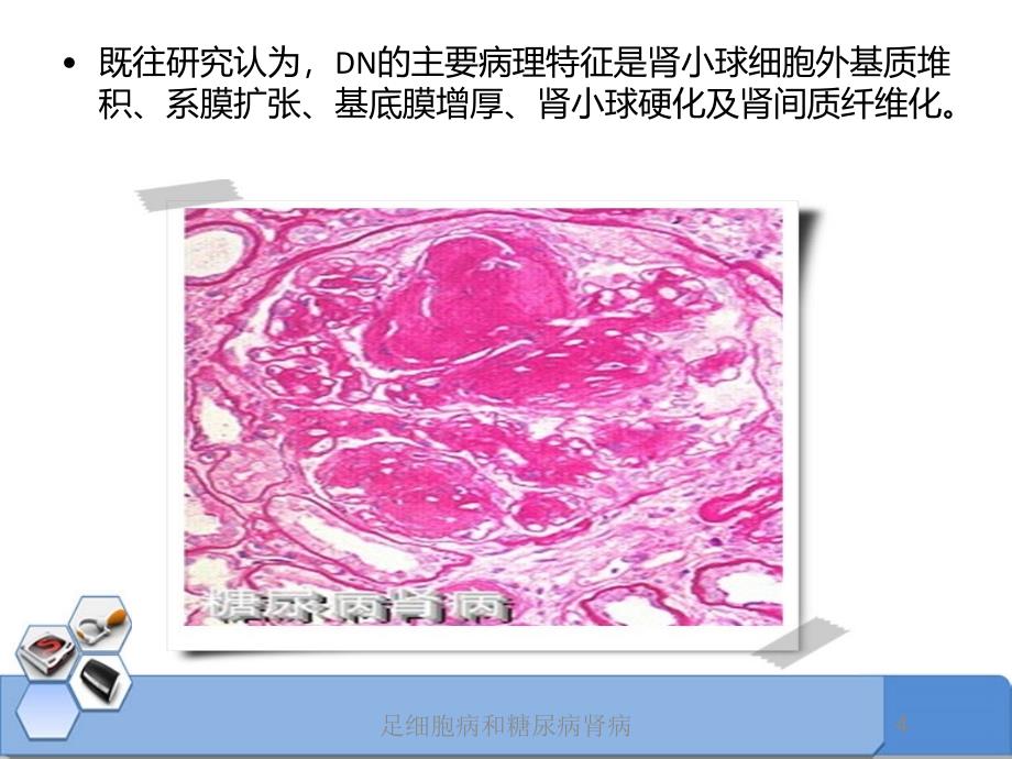 足细胞病和糖尿病肾病培训课件_第4页