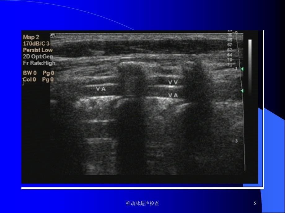 椎动脉超声检查培训课件_第5页