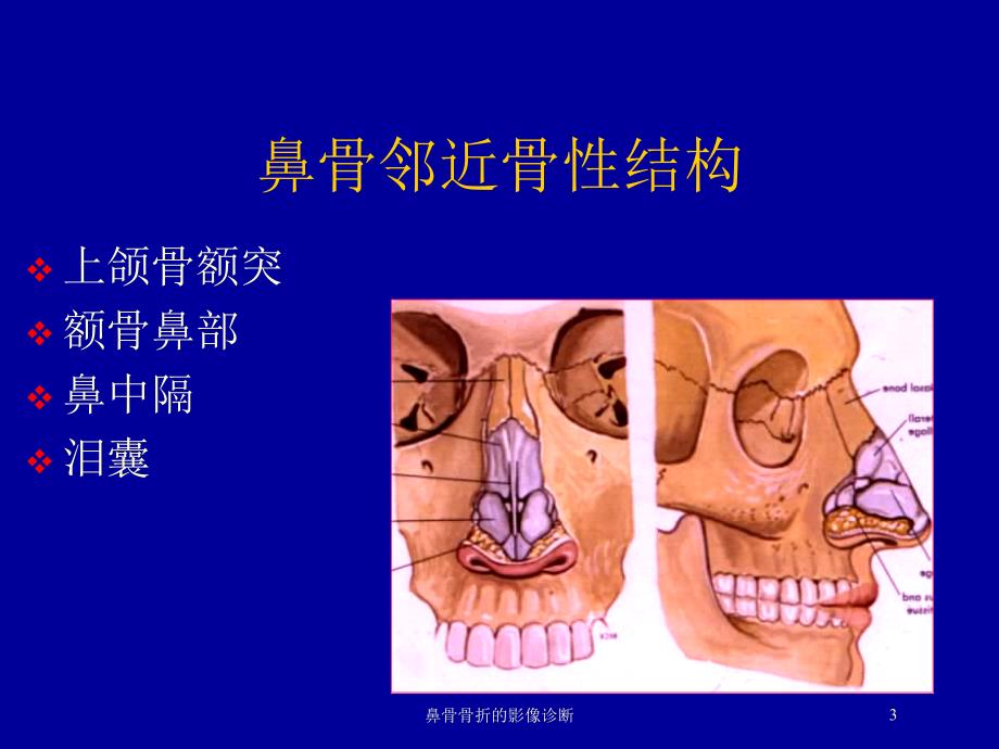 鼻骨骨折的影像诊断培训课件_第3页