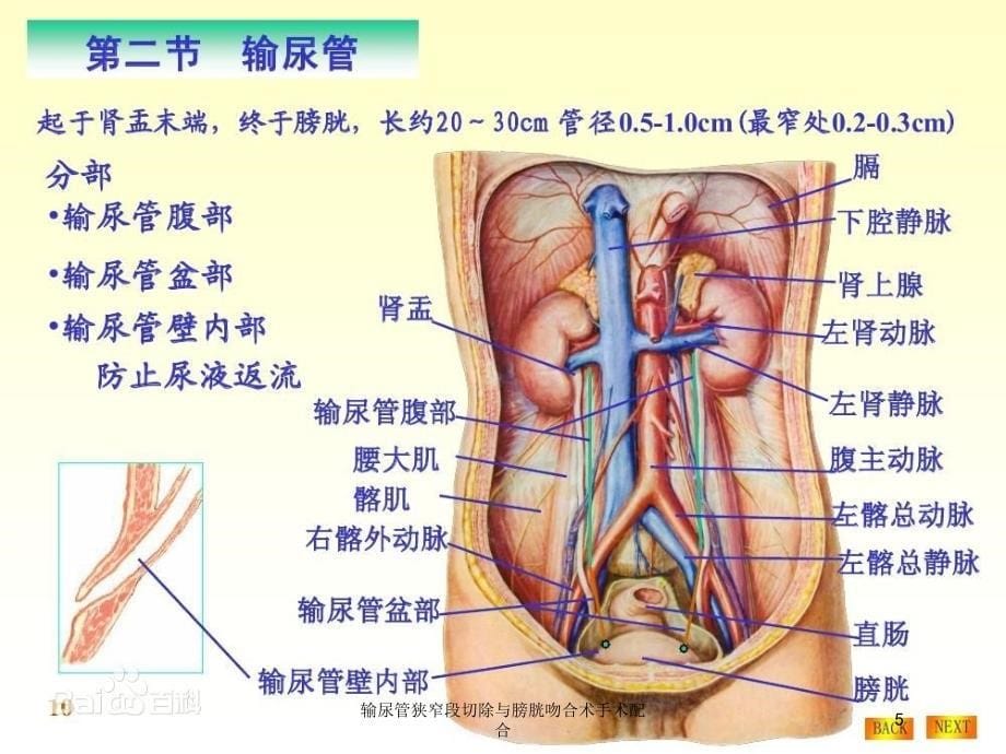 输尿管狭窄段切除与膀胱吻合术手术配合培训课件_第5页