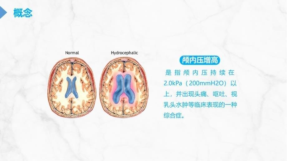 颅内压增高的护理 (2)_第5页