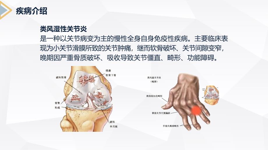 类风湿性关节炎护理查房 (2)_第4页