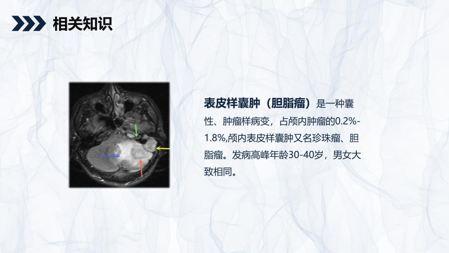 颅内表皮样囊肿患者护理查房 (2)_第4页