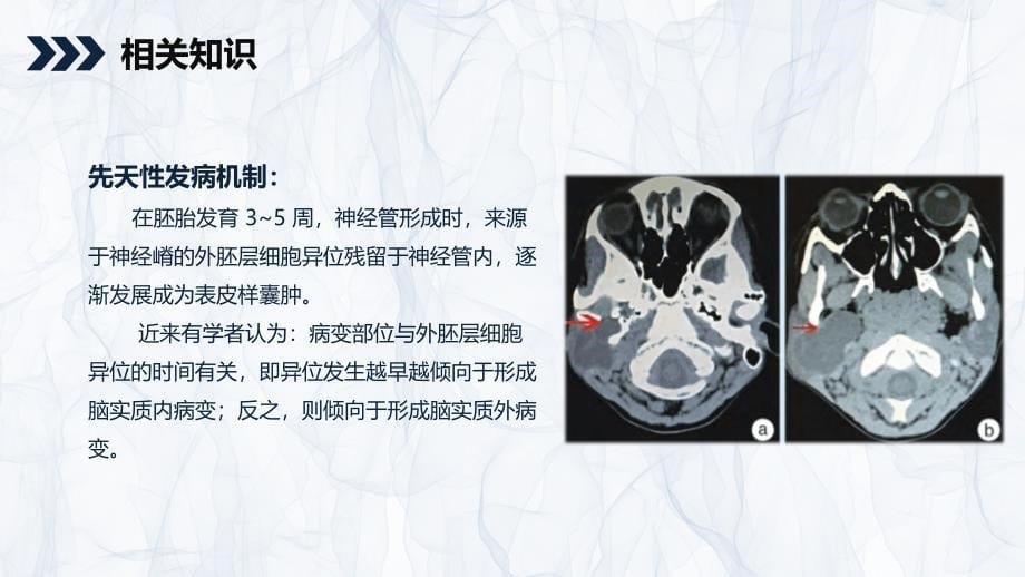 颅内表皮样囊肿患者护理查房 (2)_第5页