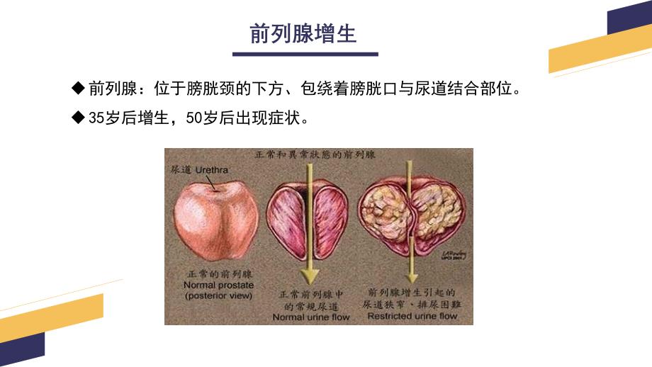 经尿道前列腺电切手术配合_第4页