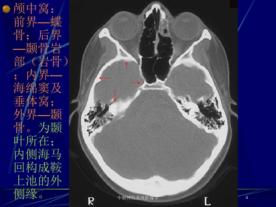 中枢神经系统影像学培训课件_第4页