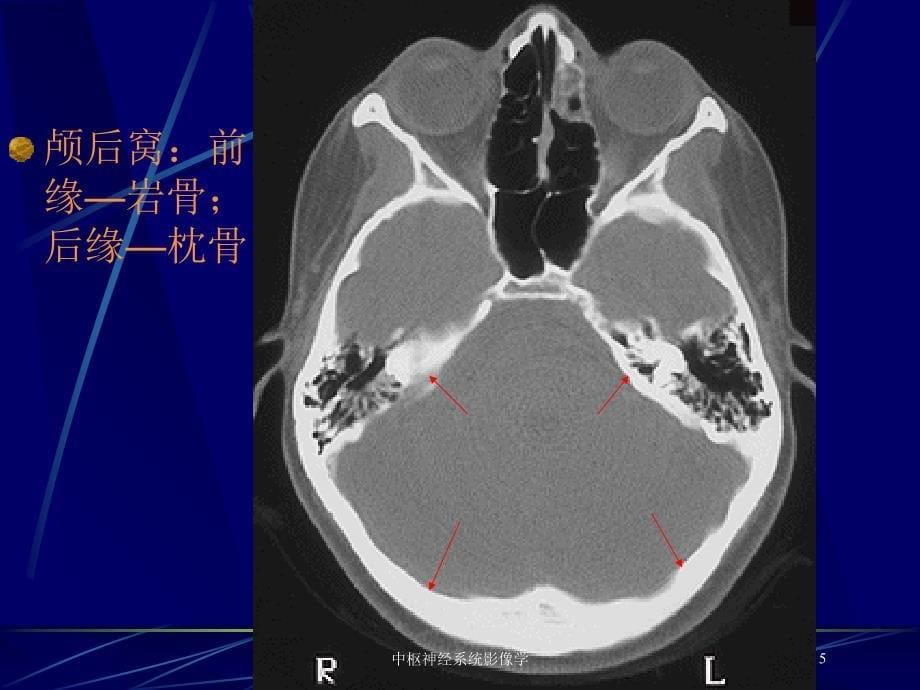 中枢神经系统影像学培训课件_第5页