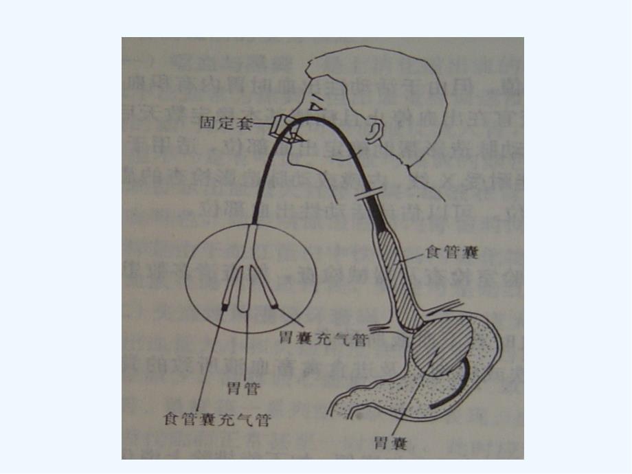 三腔二囊管的应用与护理-PPT_第3页